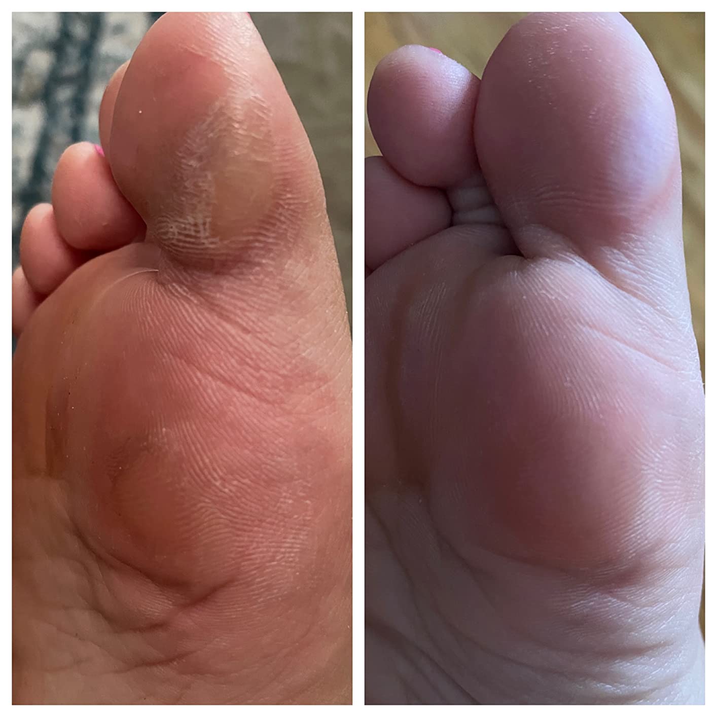 Galeve _ Callus Remover Foot