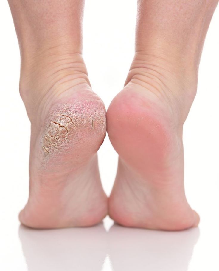 Galeve _ Callus Remover Foot